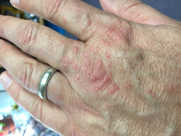 Pest Alert – English Ivy Rash | N.C. Cooperative Extension